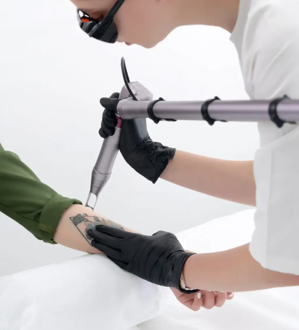 Laser Tattoo Removal