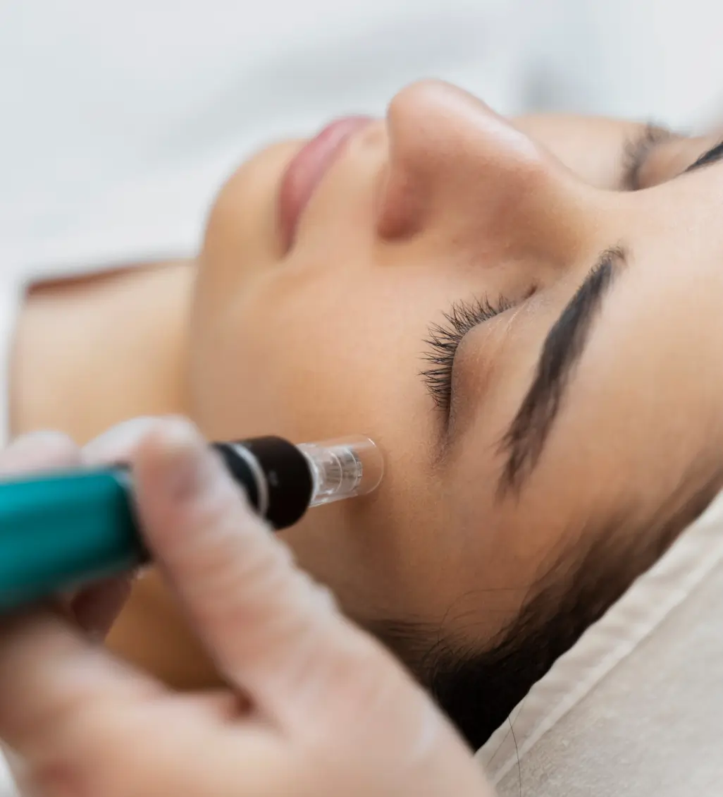 MicroNeedling